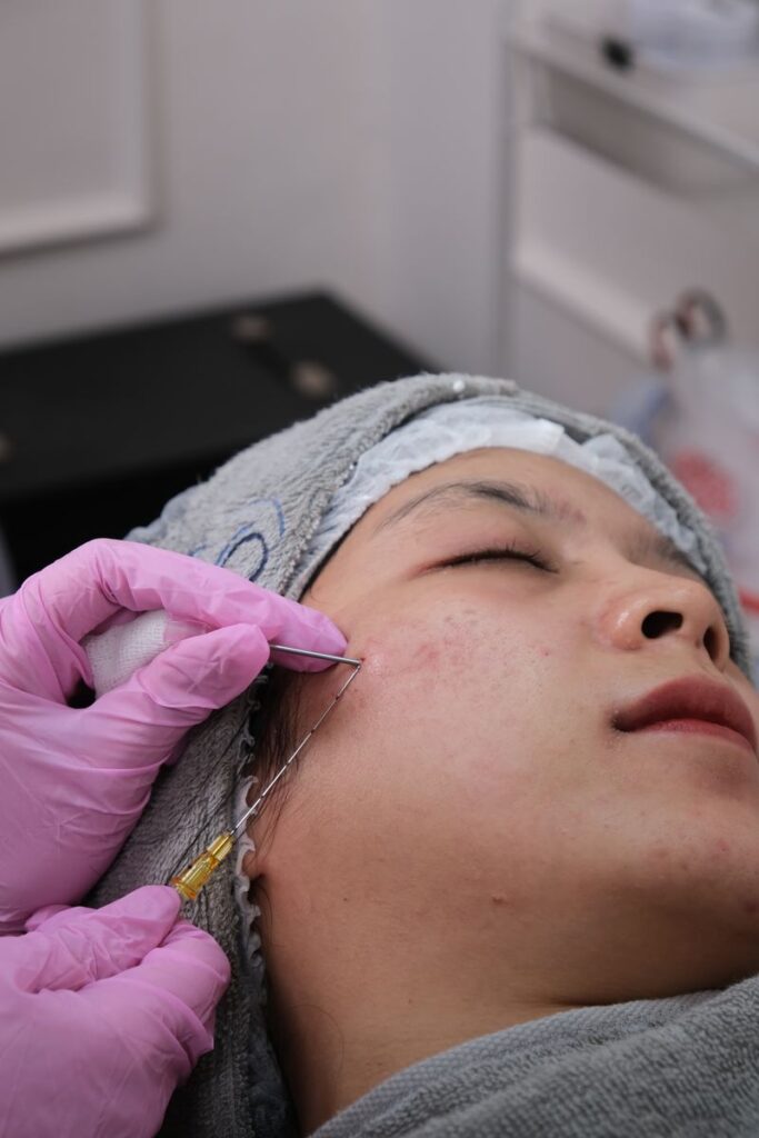 Séance de microneedling réalisée en institut de beauté